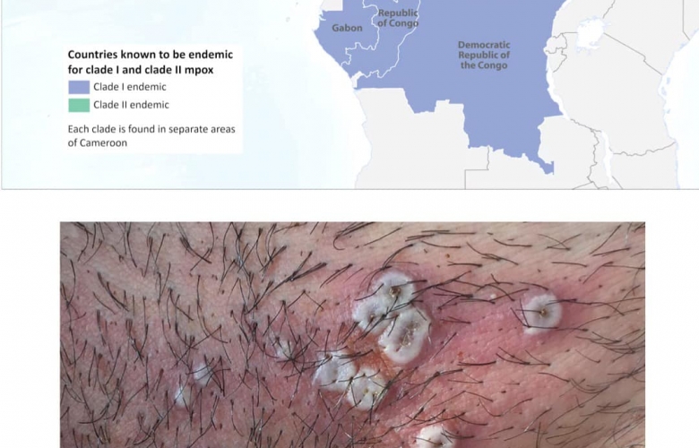 Maymun Çiçeği Virüsü, Covid-19 Sonrası Yeni Tehdit mi?